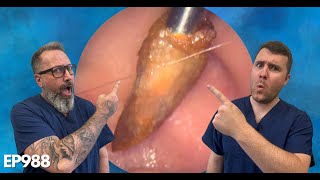 🔥 EARWAX PLUG amp SKIN REMOVAL FROM EAR EAR CLEANING  EP988 [upl. by Naul]