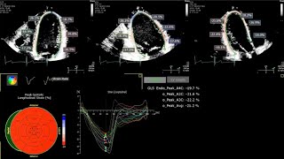 A Practical Guide to Echocardiographic Global Longitudinal Strain GLS by 2D Speckle Tracking [upl. by Nordgren554]