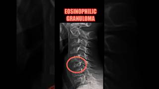 Eosinophilic Granuloma bones radiology doctor [upl. by Dualc]