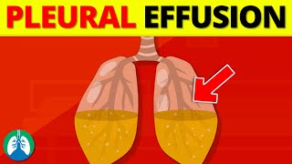 Pleural Effusion Medical Definition  Quick Explainer Video [upl. by Trevah]