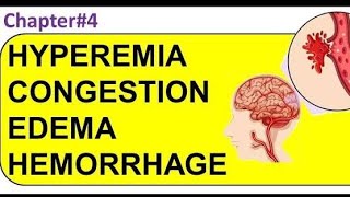 Pathology Hyperemia Congestion and Edema افضل شرح باثولوجي بالعربي الاحتقان والتورم د فادي مجدي [upl. by Nosyrb690]