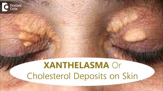 FATTY DEPOSITS of CHOLESTEROL around EYES  How to get rid of itDrRajdeep MysoreDoctors Circle [upl. by Cathee]