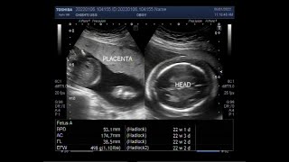 Hydrops fetalis with Fetal Soft tissue edema Ascites and Pleural effusion [upl. by Aenel53]