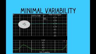 Topic 26 Intrapartum Fetal Surveillance [upl. by Llennehc852]