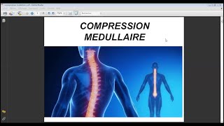 COMPRESSION MÉDULLAIRE [upl. by Cardew]