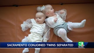 Celebrating a miracle Conjoined twin girls successfully separated at UC Davis Medical Center [upl. by Jud]