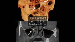 Removing a Root from the Maxillary Sinus [upl. by Akehsal]