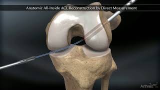 Anatomic AllInside ACL Reconstruction by Direct Measurement [upl. by Ettezyl]