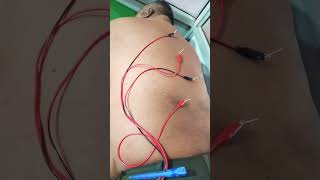 Sciatica pain Treatment by Acupuncture needles [upl. by Richard478]