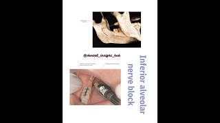 Inferior alveolar nerve block oralsurgerydentistrydentalinsighthubtoothextraction [upl. by Mouldon543]