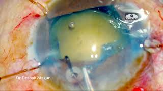 Capsule Tension Ring CTR part 3 final CTR in SICS case Dr Deepak Megur [upl. by Lletnahc]