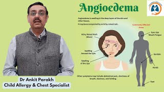 Angioedema in children Symptoms Diagnosis amp Treatment Dr Ankit Parakh Allergy Specialist [upl. by Cataldo]