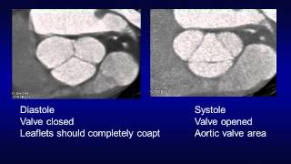 When do I have to perform a gated chest CT [upl. by Yanel373]