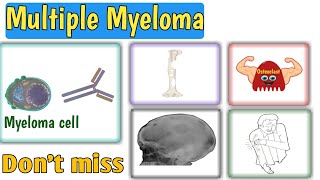 Multiple Myeloma  Causes  Pathophysiology  Signs amp symptoms  Diagnosis  Treatment [upl. by Enitsua]