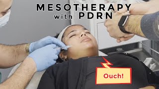 PDRN Mesotherapy AKA Biorejuvination 100 needles in my face skincare [upl. by Eirak]