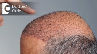 When will newly transplanted hair start to grow  Dr Niranjana Raj [upl. by Olive611]