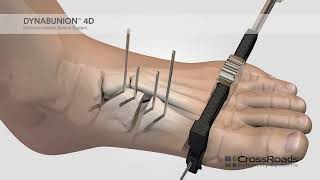 dynaBunion™ 4D MinimalIncision Lapidus System  Surgical Animation [upl. by Ghiselin606]