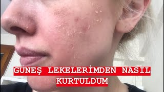 EYLÜL ÖZTÜRKGÜNEŞ LEKELERİMDEN NASIL KURTULDUMCİLTBAKIMI [upl. by Marnia]