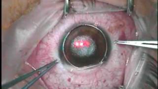 Intralase LASIK in a case with nystagmus [upl. by Yrrah164]