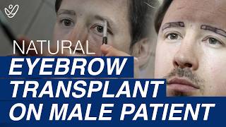 Eyebrow Transplant for MEN  Get the Perfect Eyebrows [upl. by Avictor494]