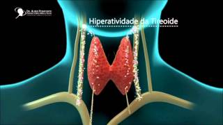 Tireoidectomia  Cirurgia de Tireoide [upl. by Gierk435]