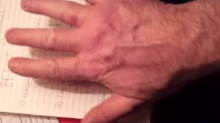 SKIN SPOTS BLOOD BLISTERS RASH SCABS ZOMBIE VIRUS AGENDA 21 [upl. by Dajma338]