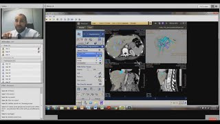 Webinar segment 3 CT Liver Analysis by Prof Saade [upl. by Eixel]