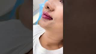 Lip Fillers Technique by Dr Muskan Tyagi  Dermalyn Aesthetics  APPOINTMENT CALL 9999189391 [upl. by Seidler820]