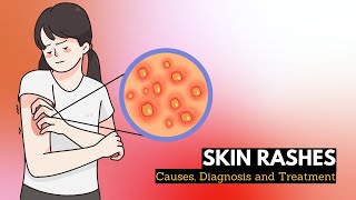 Skin Rash Causes Signs and Symptoms Diagnosis and Treatment [upl. by Onaicilef]