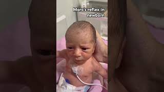 Moro’s reflex newbornbaby nicu pediatrician healthcare babycare newlyborn neuroexam [upl. by Flanders]