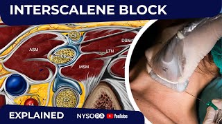 USGuided Interscalene Brachial Plexus Block  Regional anesthesia Crash course with Dr Hadzic [upl. by Notsuj631]