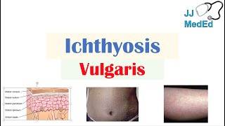 Ichthyosis Vulgaris  Causes Signs amp Symptoms Diagnosis Treatment [upl. by Onivag]