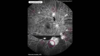 PROLIFERATIVE DIABETIC RETINOPATHY FLUORESCEIN ANGIOGRAPHY ANALYSIS For more images like this visit [upl. by Ania]