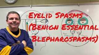 Eyelid Spasms Benign Essential Blepharospasm [upl. by Calore997]