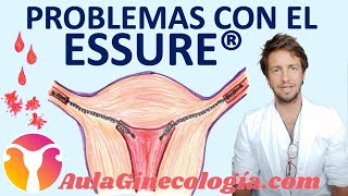 PROBLEMAS DEL ESSURE® QUÉ ES EFECTOS SECUNDARIOS y CÓMO RETIRARLO  Ginecología y Obstetricia [upl. by Bakeman]