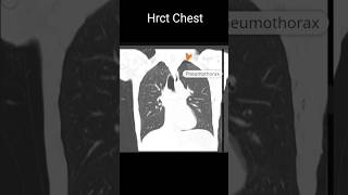 Pneumothorax shortfeeds [upl. by Hollister338]