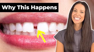 Why Do People Have GAP TEETH amp How To Fix It Diastema Explained [upl. by Eladal]