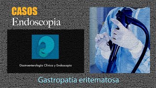 Gastropatía eritematosa [upl. by Hassett]