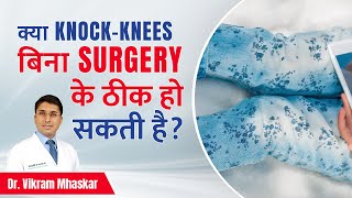 🟢 क्या KnockKnees बिना Surgery के ठीक हो सकती है  How to Fix KnockKnee Without Surgery [upl. by Nealy]