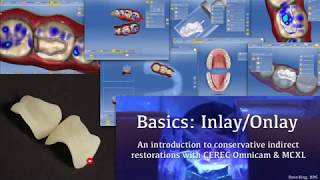 Basics of Inlays and Onlays  Conservative Indirect Restoration with CEREC Omnicam and MCXL [upl. by Llenreb299]