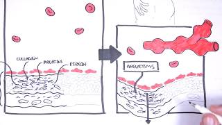 Polyarteritis Nodosa and Kawasaki Disease Medium Vessel Vasculitis  Symptoms pathophysiology [upl. by Royden]