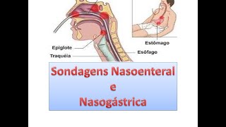 Sondagem Nasoenteral e Nasogástrica  Boneco simulação [upl. by Janus695]