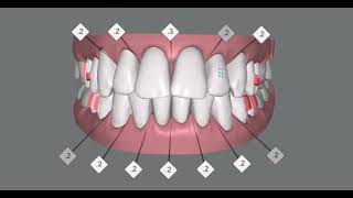 Alignment and intrusion of anterior teeth of an adult patient invisalign clincheck simulation [upl. by Arramas]