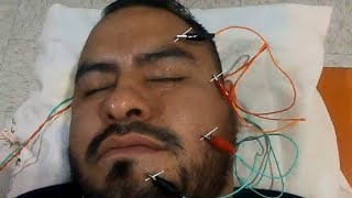 Parálisis Facial terapia con Acupuntura Masaje Foco Rojo y Electricidad [upl. by Caputo774]