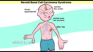 Gorlin syndrome nevoid basal cell carcinoma syndrome  Mnemonic  easy learning [upl. by Suirauqram]