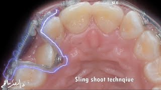 slingshot techenique to solve canine crossbite [upl. by Nednerb]