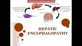 Hepatic encephalopathy and the real case study 🏥 [upl. by Eittod]