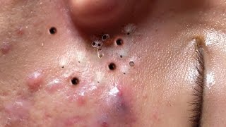 Blackheads amp Acne Treatment Latest Update 54 [upl. by Hiller]