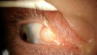 Ophthalmology finding Inclusion cyst on the eye [upl. by Ellery]