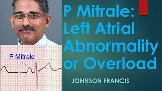 P Mitrale – Left Atrial Abnormality or Overload [upl. by Koralie]